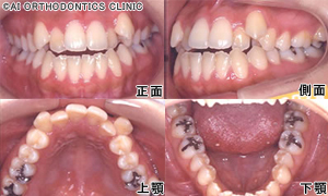 Step1.医院探し 裏側矯正で治療する!