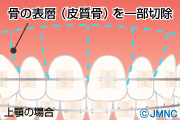 コルチコトミー