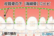 ヘミオステオトミー・コルチコトミー
