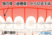オステオトミー