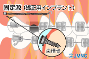インプラント矯正