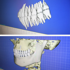 3Dデジタル裏側矯正