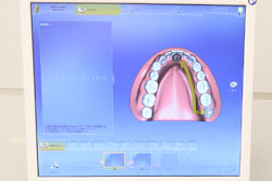 3Dデジタル機器を活用した矯正治療