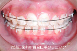審美ブラケット