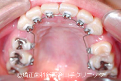 リンガルブラケット