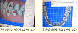 歯列のシミュレーション画像