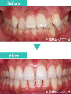 マウスピース矯正のbefore&after