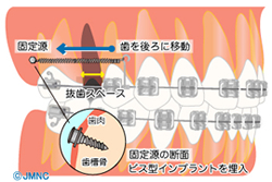 インプラント矯正