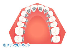 裏側矯正