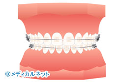審美ブラケット