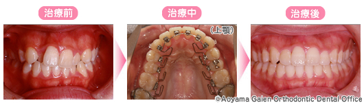 「叢生」をハーフリンガルで治療した写真
