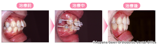 「上下顎前突」を表側矯正で治療した写真