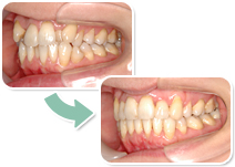 スピード矯正で10ヵ月で改善した例