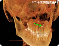 埋伏過剰歯(矢印)の位置
