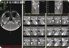 CTによる顎関節の分析