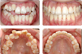 叢生をアンカースクリュー矯正で治療した症例
