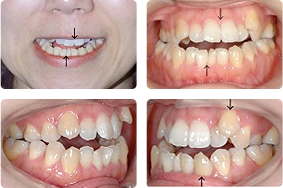 【治療例】 叢生をアンカースクリュー矯正で治療した症例