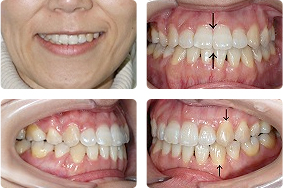 【治療例】 叢生をアンカースクリュー矯正で治療した症例
