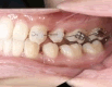 ※インビザライン単独では歯列矯正が不可能な場合には。