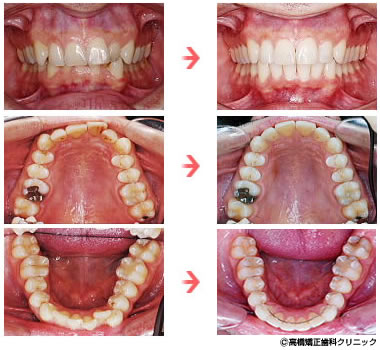 治療後の比較（口腔内）