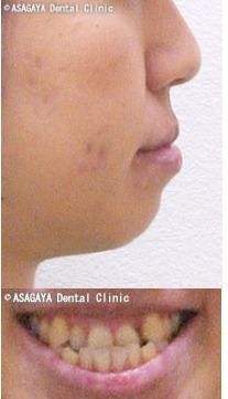 治療例1　治療前後の横顔（側貌）治療前