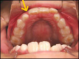 お子様の乱ぐい歯を拡大矯正装置で治療した例治療前