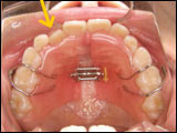 お子様の乱ぐい歯を拡大矯正装置で治療した例治療中