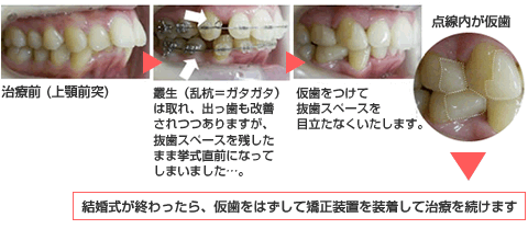 ブライダル矯正の一例 矯正歯科ネット