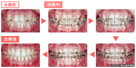 【治療例】 治療写真(上2本、下2本の小臼歯を抜歯して治療した例)
