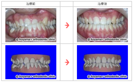 反対咬合の症例写真