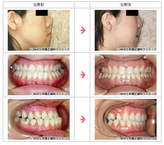 1.下顎前突症(35歳・女性 ブラケット装着期間25ヵ月)