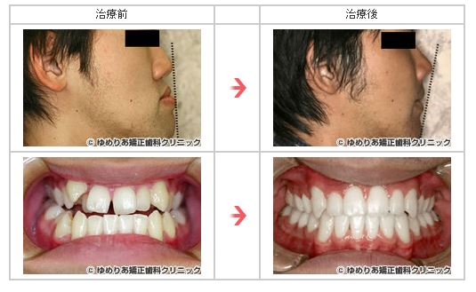 2.下顎前突症(22歳・男性 ブラケット装着期間23ヵ月)