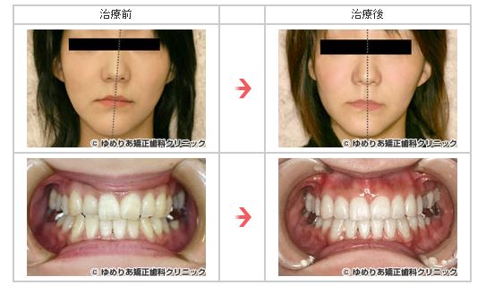 3.非対称症(35歳・女性 ブラケット装着期間18ヵ月)