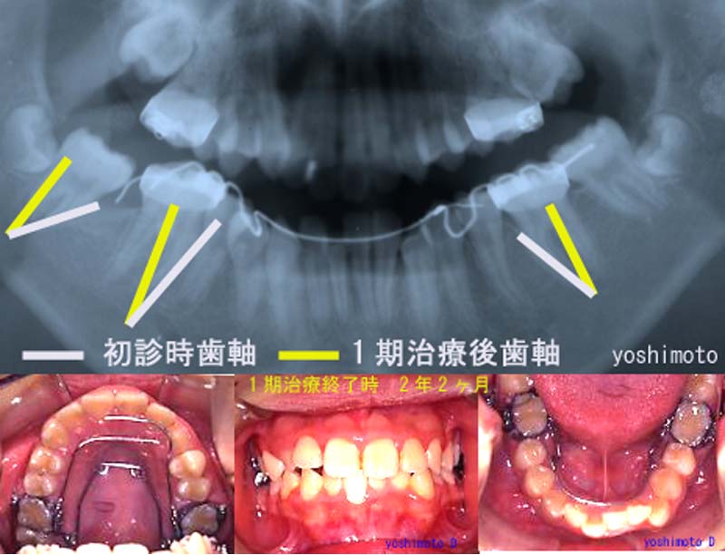 １期治療　2年2ヶ月