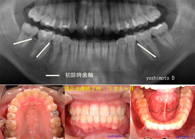 矯正終了時　15才5ヶ月（２期治療　１年３ヶ月）