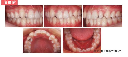 歯の大きさのバランスが悪い不正咬合の症例 矯正歯科ネット