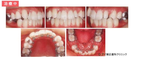 裏側矯正装置を装着して治療開始