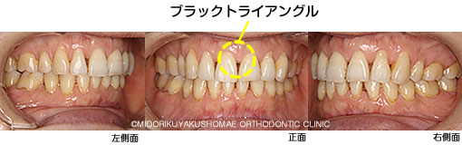 ブラックトライアングル治療前の口腔内写真