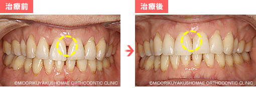 治療前後の比較 (正面)