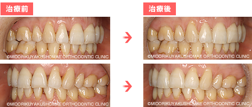 治療前後の比較 (側方)