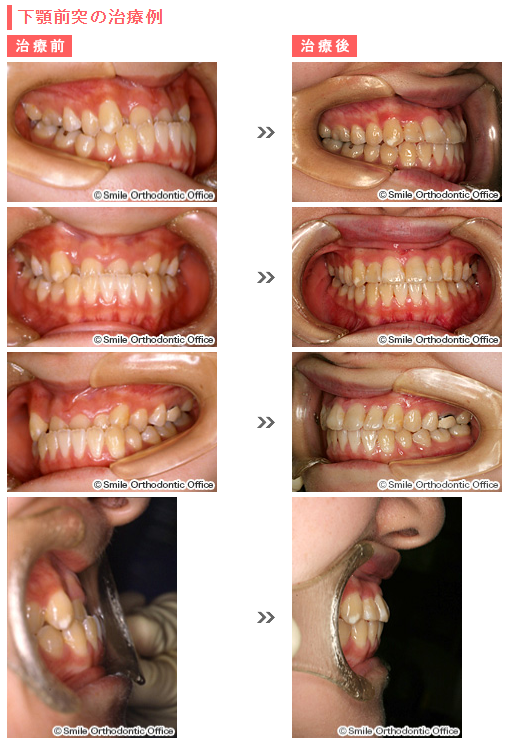 下 の 歯 が 前 に 出 てる 治し 方