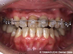 STEP3　前歯のかみ合わせを改善