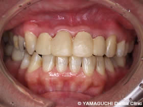 STEP5　上顎の歯4本に仮歯