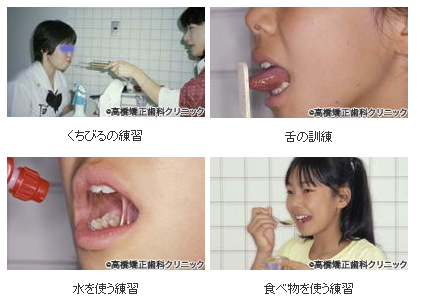 口腔筋機能療法（MFT）