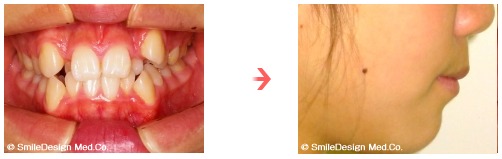 出っ歯と歯の凸凹が気になり矯正歯科に来院
