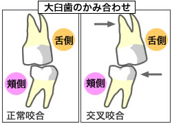 交叉咬合とは