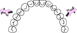 歯列自体の側方への拡大