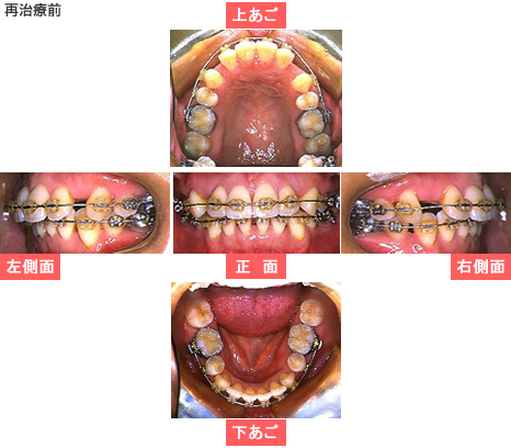 再治療前