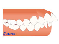 上顎前突