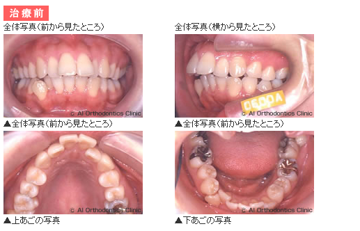 スポーツを続けながら裏側矯正 舌側矯正 で凸凹 出っ歯を治療した例 矯正歯科ネット